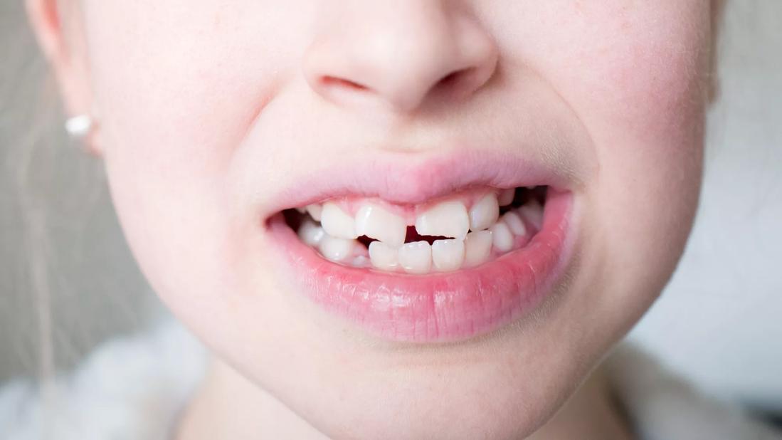 Close up of child's chipped teeth