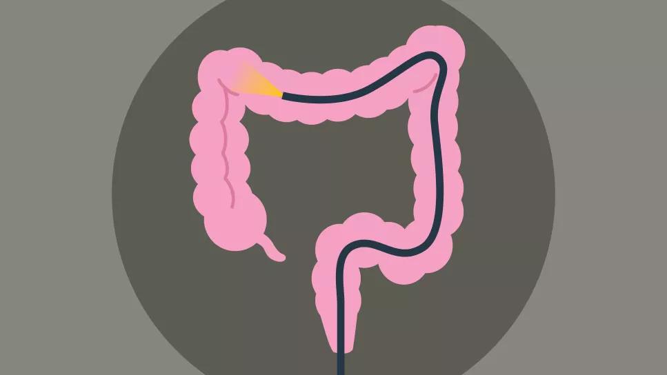 Colonscopy exam showing light inside colon