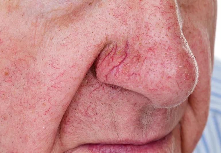 spider veins on man's nose and face