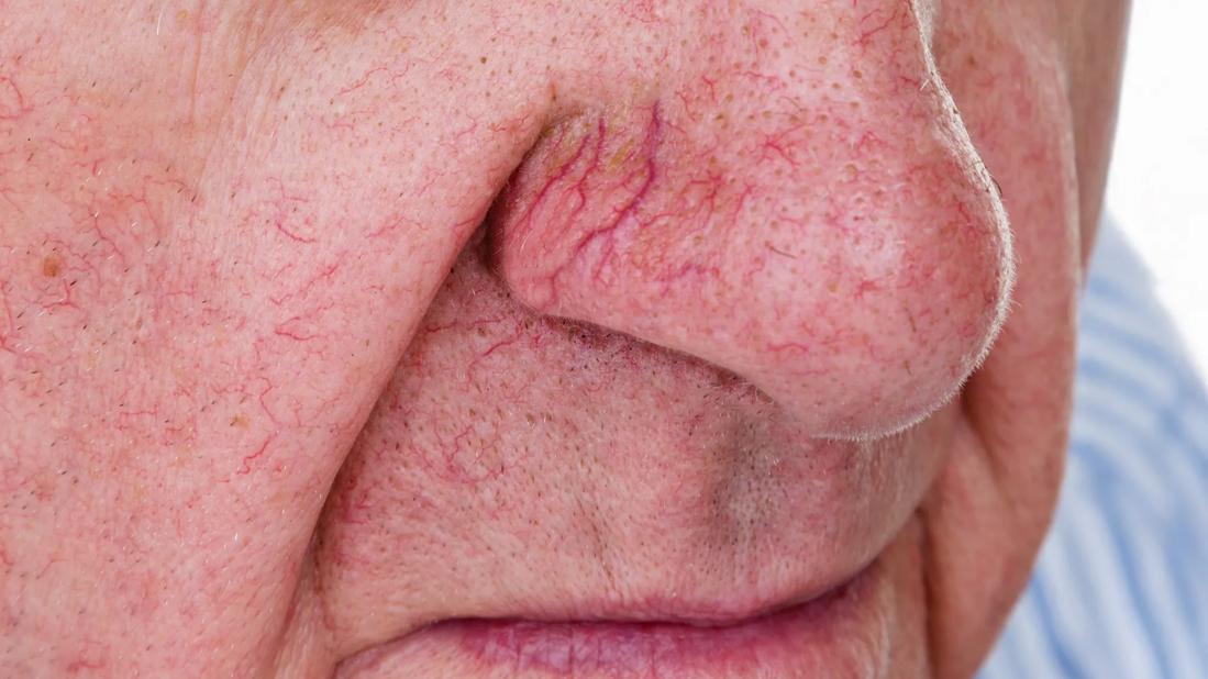 spider veins on man's nose and face