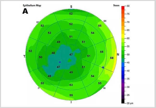 22-EYE-2905316 CQD _ Eligibility for refractive surgery (Randleman)650X450_HERO