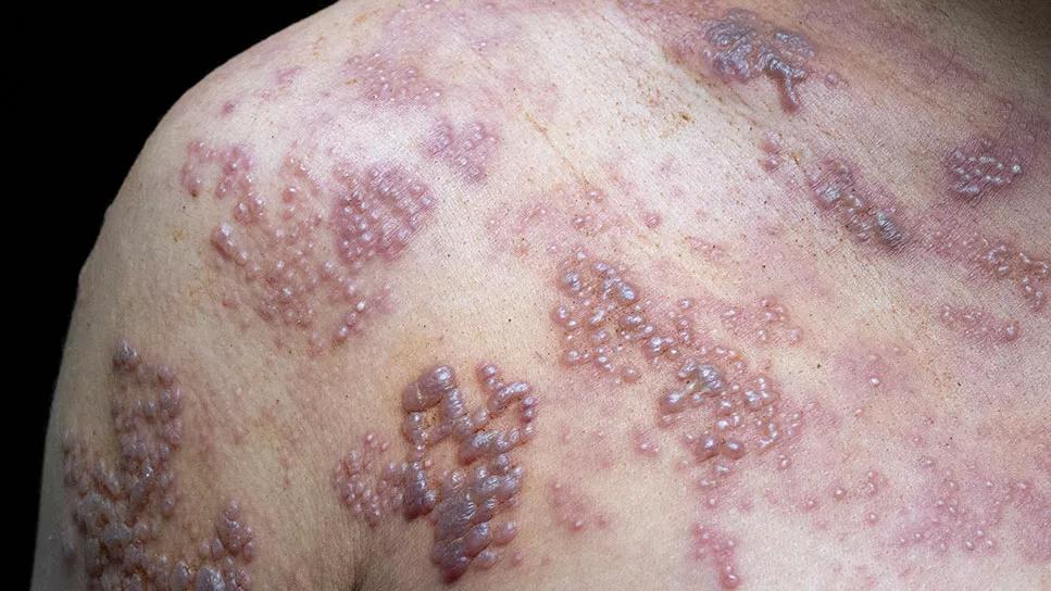 Closeup of shingles virus presenting on shoulder of person