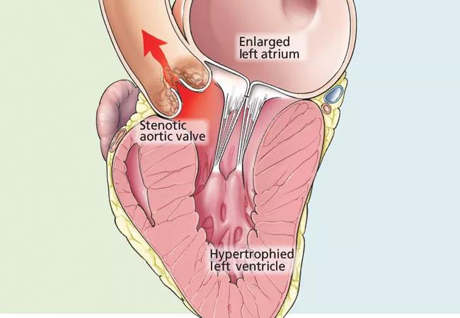 16-hrt-2058-aortic-stenosis-cqd-650&#215;450