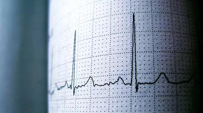 650&#215;450-EKG-PEDS-Cardiac-Death