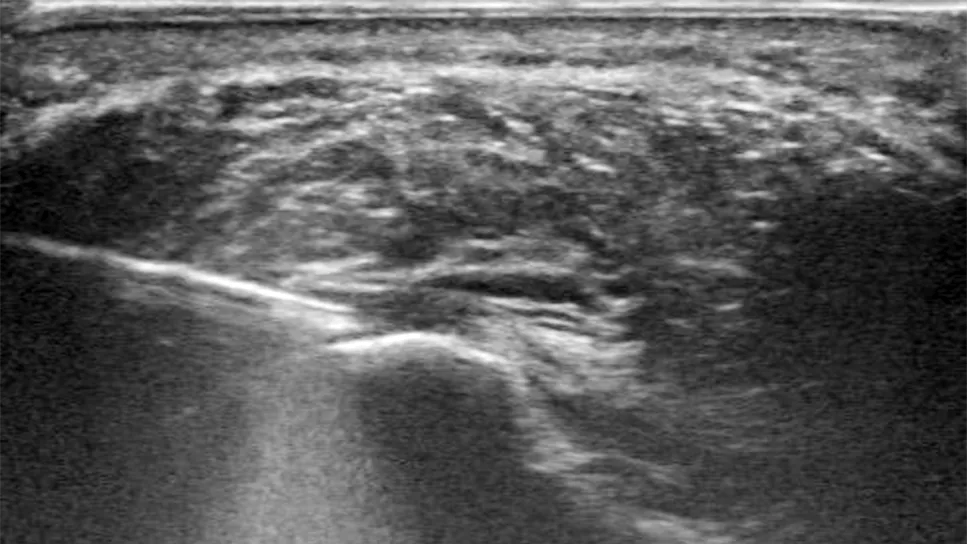 Hydroresection of plantar fascia