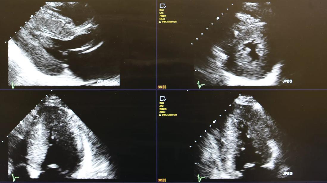 Echocardiogram demonstrating left ventricular hypertrophy and typical bright speckled appearance