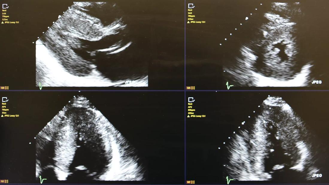 Echocardiogram demonstrating left ventricular hypertrophy and typical bright speckled appearance