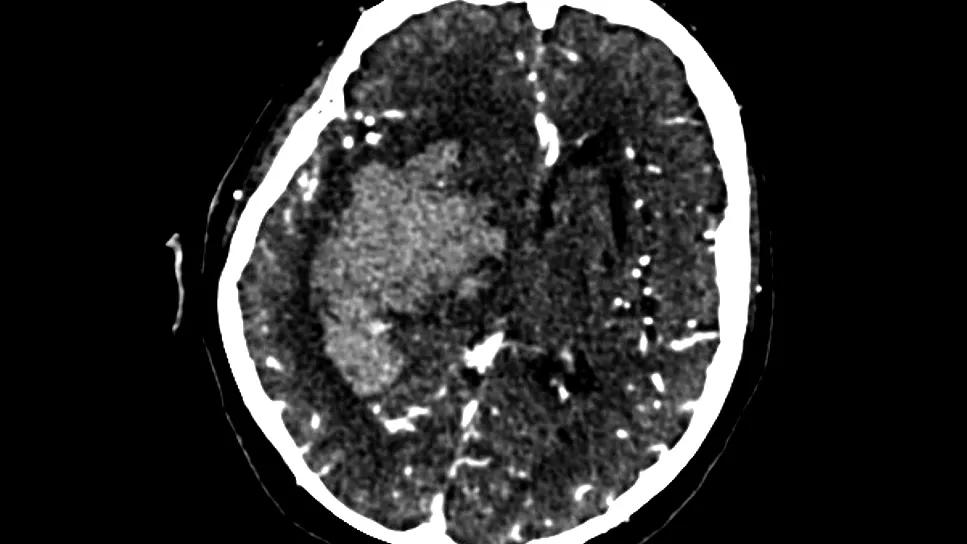 intracranial hemorrhage in the basal ganglia as shown on a brain scan