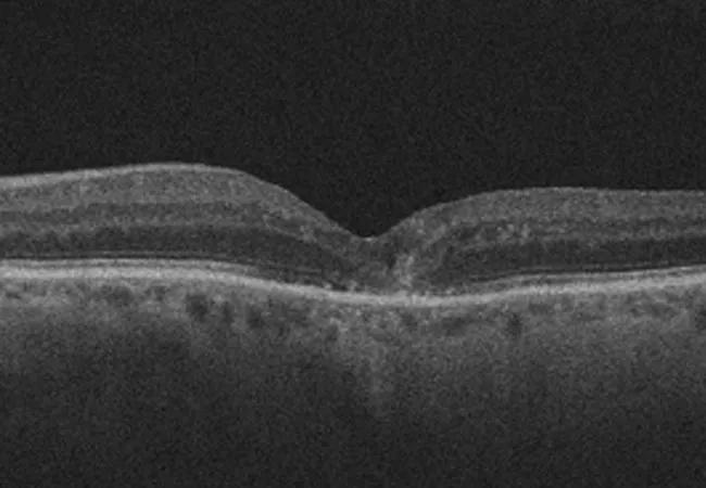 20-EYE-1964900-Lapse-in-AMD-and-DME-treatment-Hero