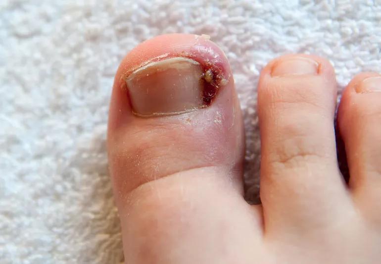 Ingrown and infected toenail