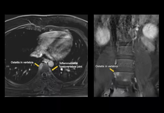 21-RHE-2528456-Osteitis-and-acne-SAPHO-syndrome-CQD_650x450