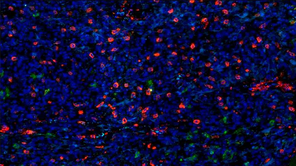 macrophages and microglia in glioblastoma tumors