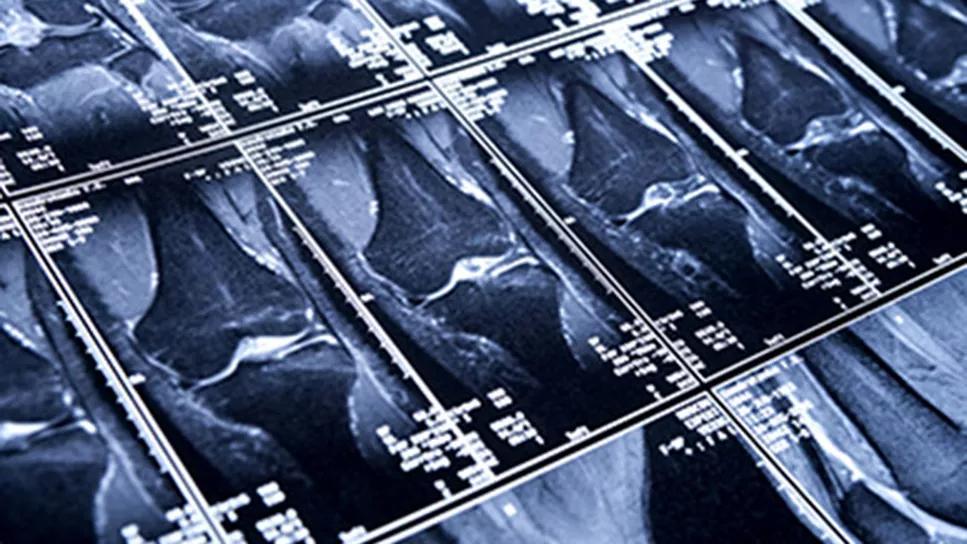 Multiple MRI scans of knees