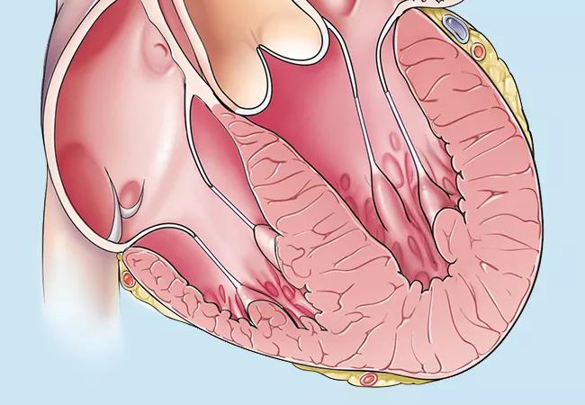 22-HVI-2769712_hyptertrophic-cardiomyopathy_650x450