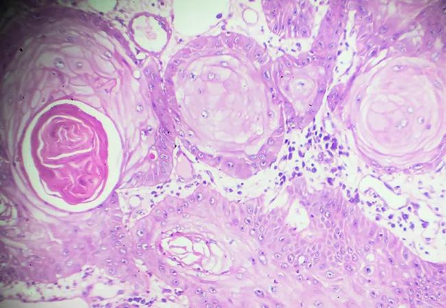 Squamous Cell carcinoma under microscopy