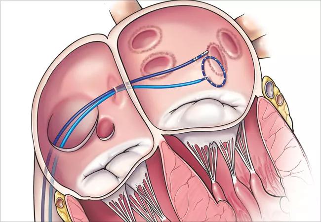 20-HVI-1892867-ablation-roundup-650&#215;450-2