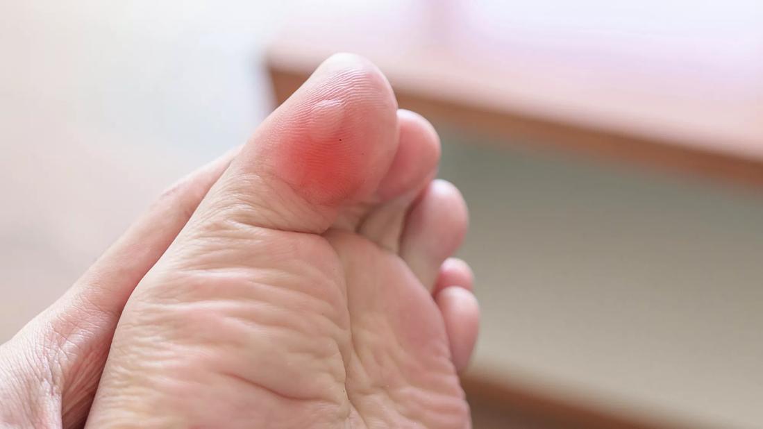 Blister on bottom of big toe