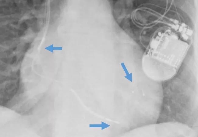 image of a patient with a cardiac resynchronization therapy (CRT) device with arrows pointing to the three leads used in CRT