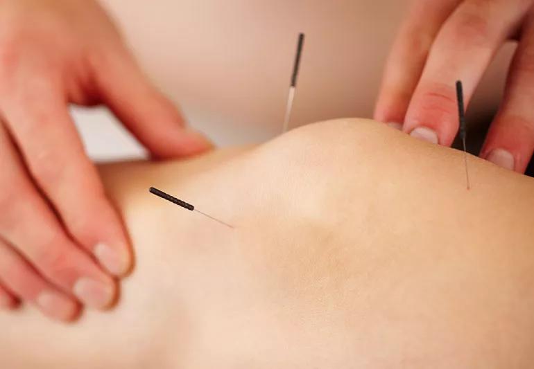 acupuncture on knee