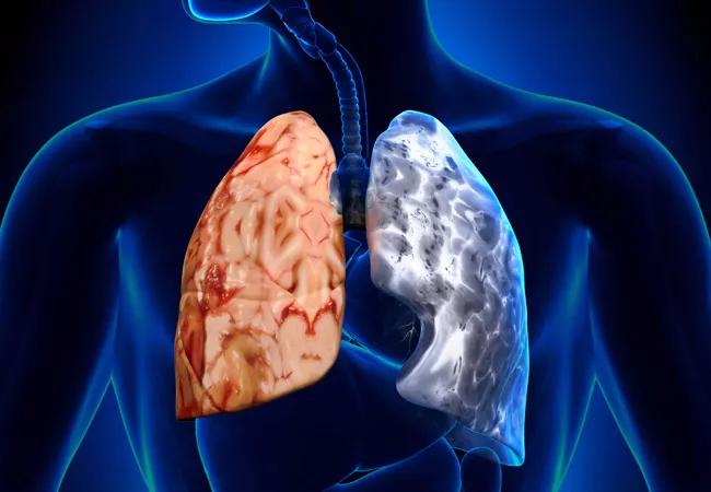 lung transplant