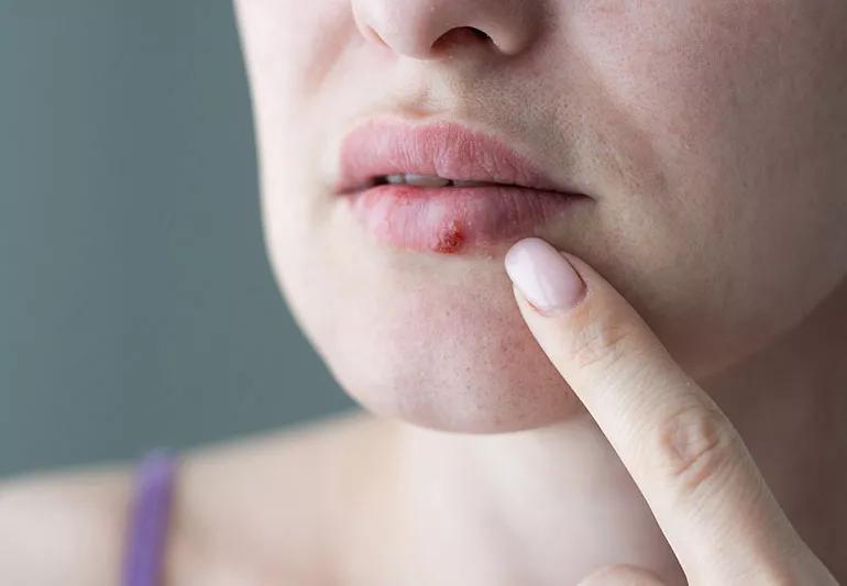 Close-up of individual pointing to their cold sore