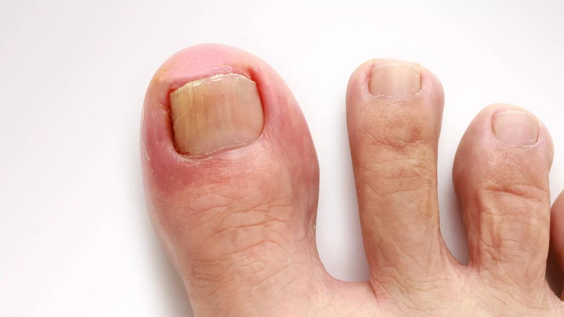 Ingrown toenail on big toe