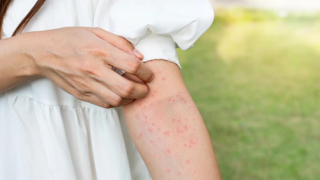 Arms of person standing outside, scratching a dotted red rash on arm