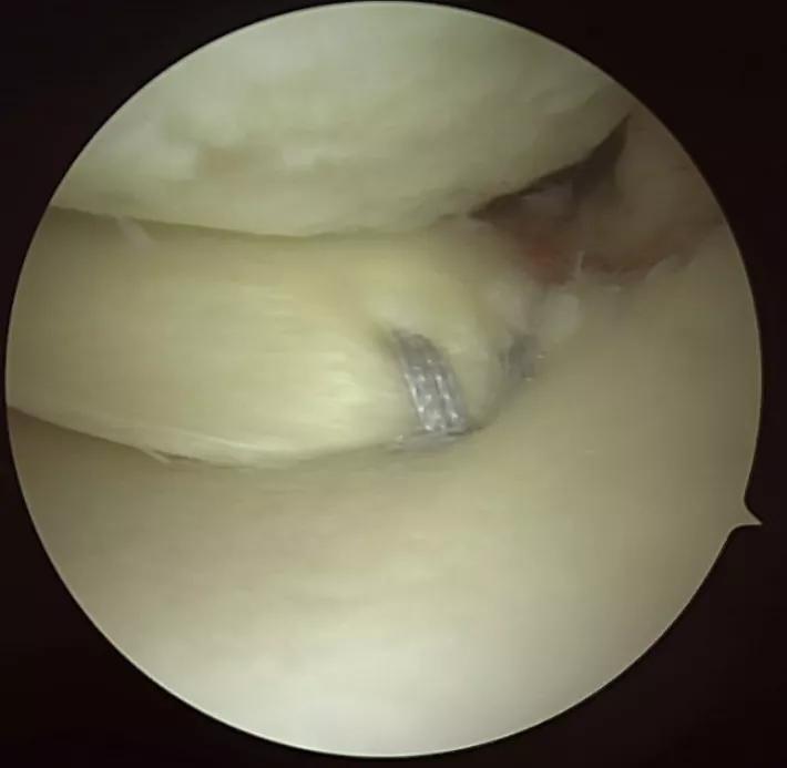 A torn meniscal root with sutures