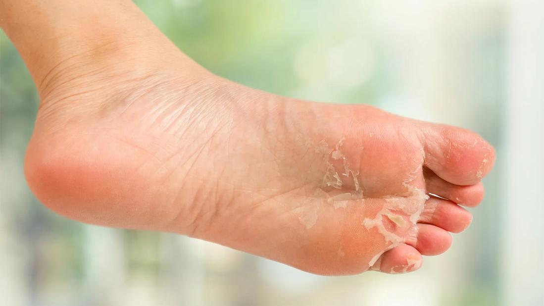 Bottom of foot with peeling skin