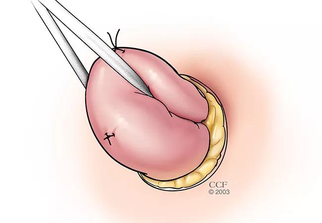 Loop ileostomy