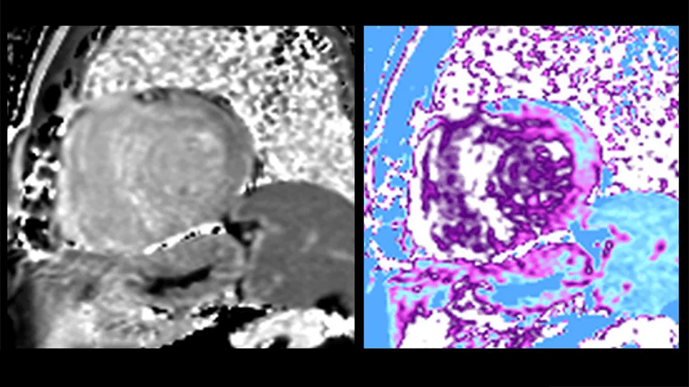 cardiac amyloidosis as seen on cardiac MRI