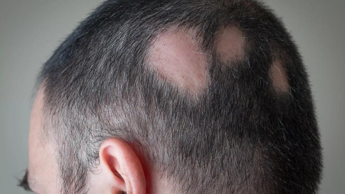 Person with alopecia areata