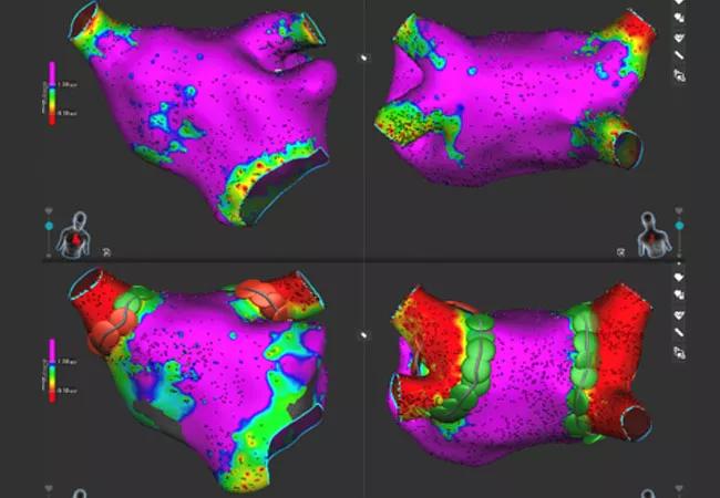 20-HVI-1886644-ablation-heart-mapping-650&#215;450