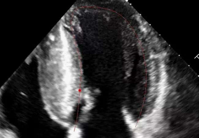 LV Strain May Offer Independent Prognostic Utility in Obstructive Hypertrophic Cardiomyopathy