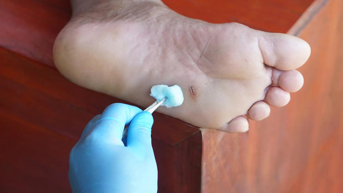 The bottom of a foot with a cut in it being dabbed with cotton by gloved hand