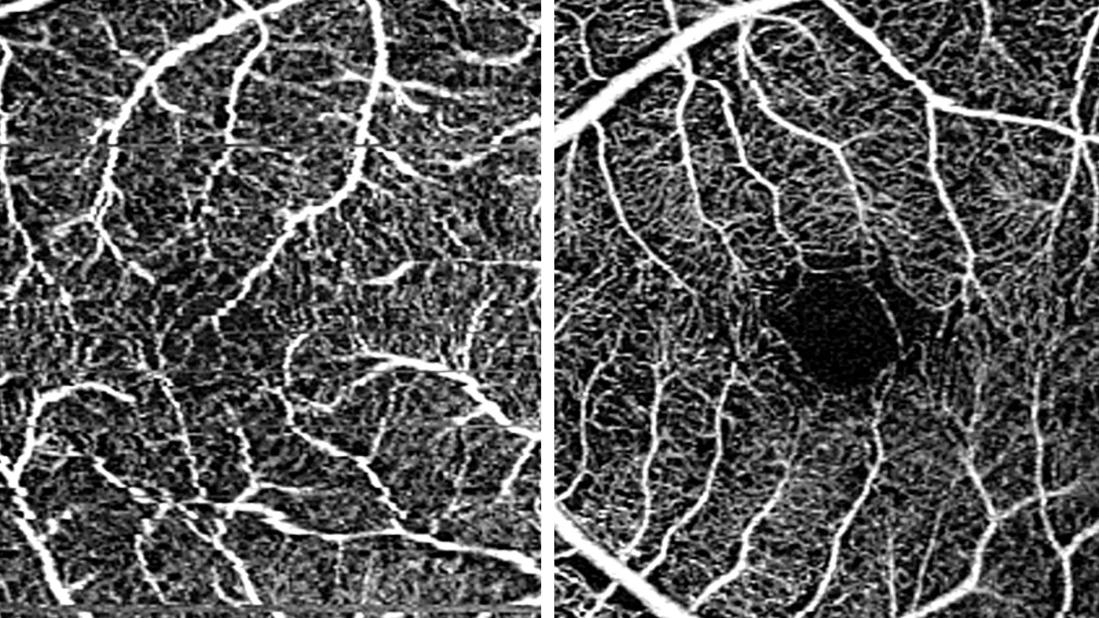 Blood vessels in the macula of adults with preterm birth versus full-term birth