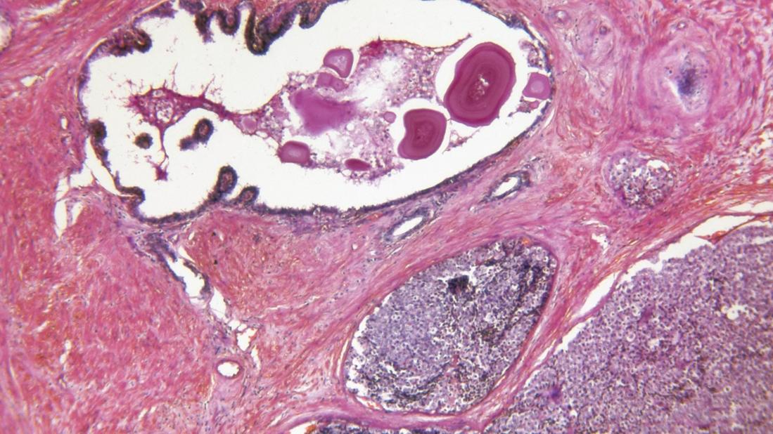 Cleveland Clinic Researchers Validate Link Between Genetic Variant