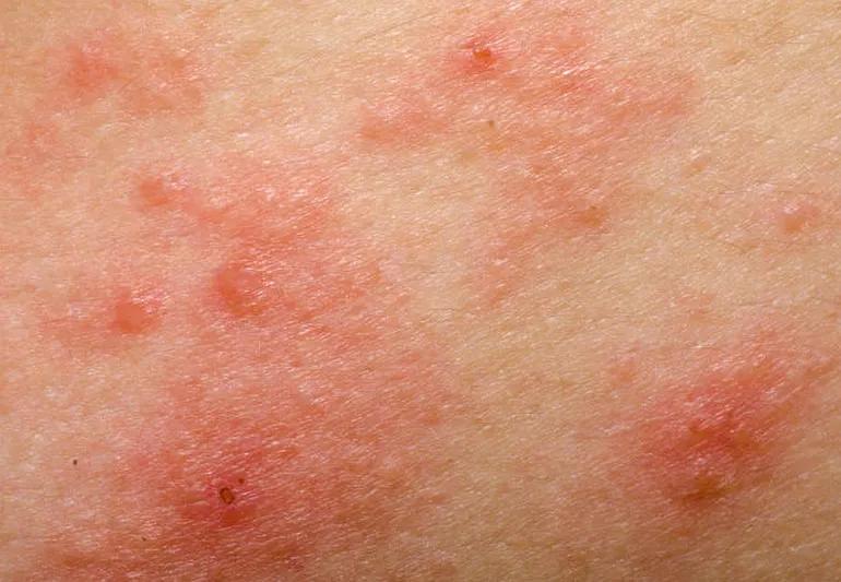 phototxicity skin rash