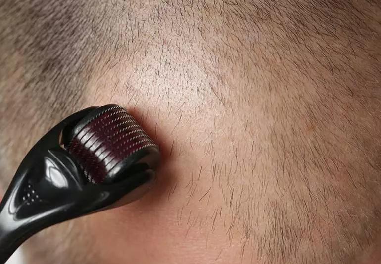 Person using a microneedle dermaroller on scalp.