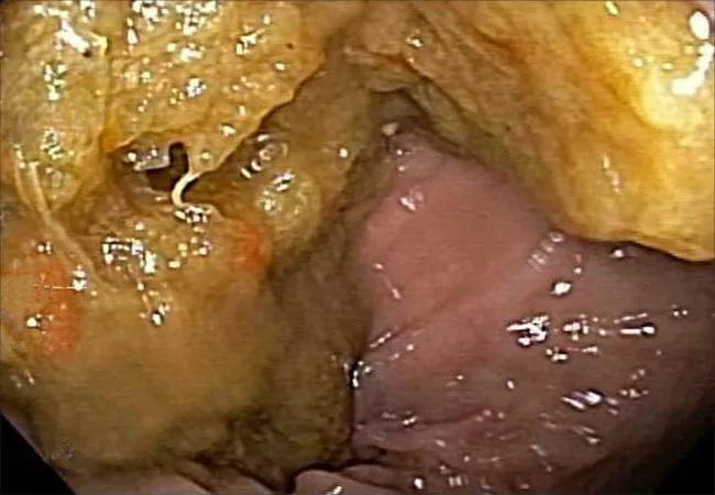 18-DDI-5580-dirtyColon-Burke-ACG_650x450