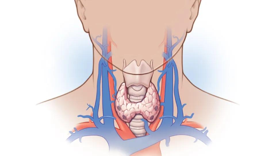 medical illustration of parathyroidectomy