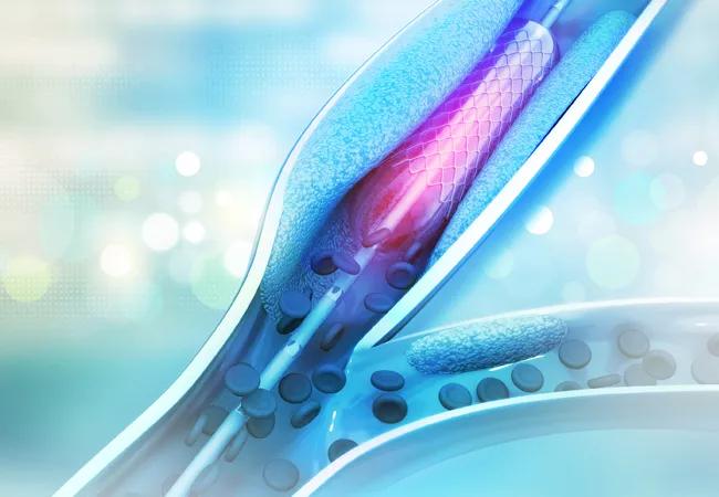 percutaneous coronary intervention