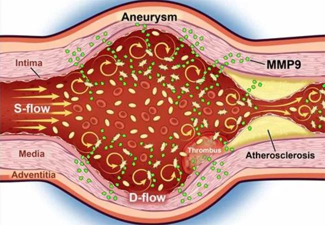 Platelet Olfactory Receptor Identified as Possible AAA Biomarker and ...