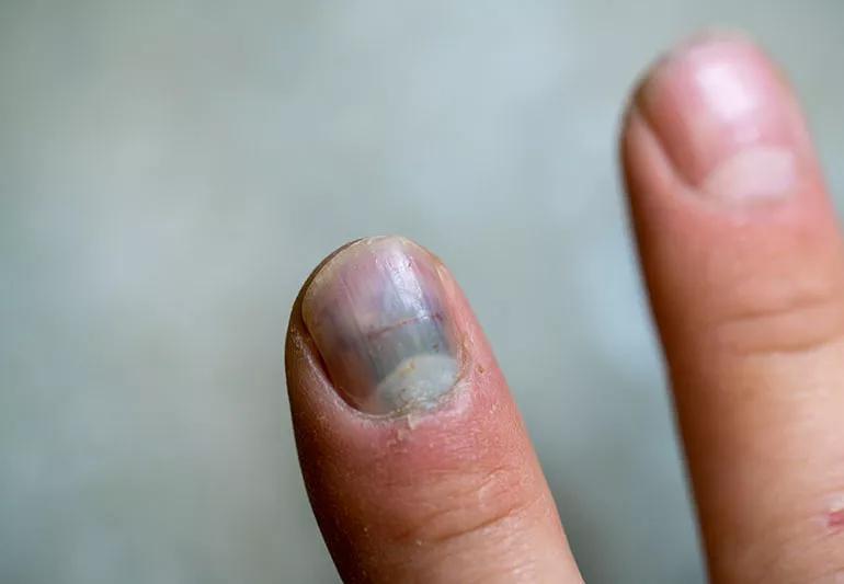 A person holds up a bruised fingernail next to a healthy fingernail.