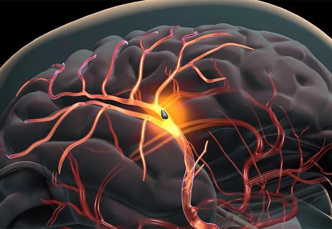 19-HRT-4026 Kapadia_stroke-risk-TAVR-650&#215;450