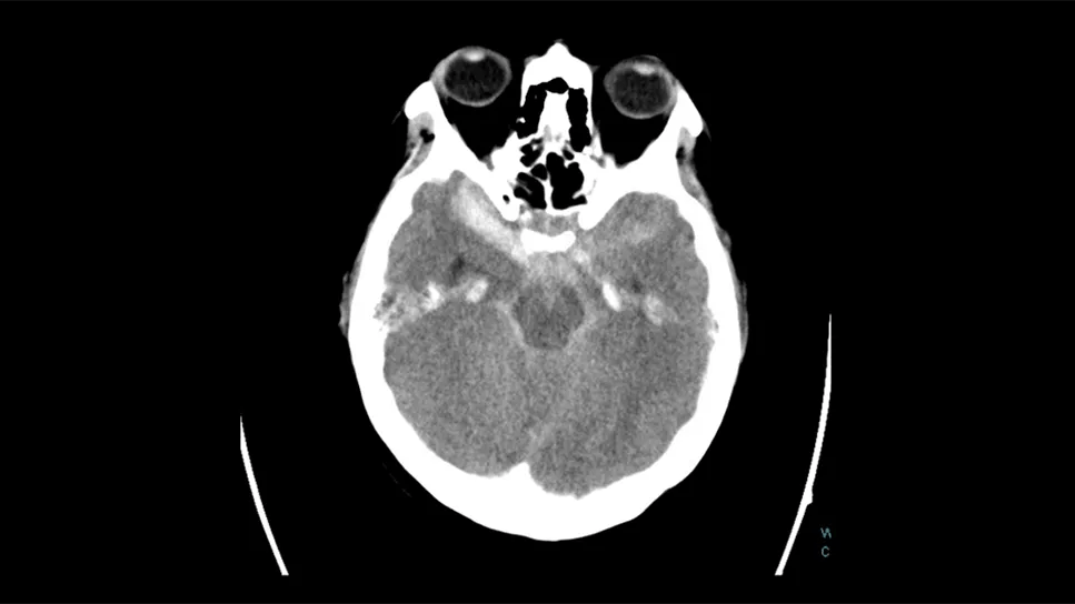 Case Study of Ruptured Grade 5 Brain Aneurysm