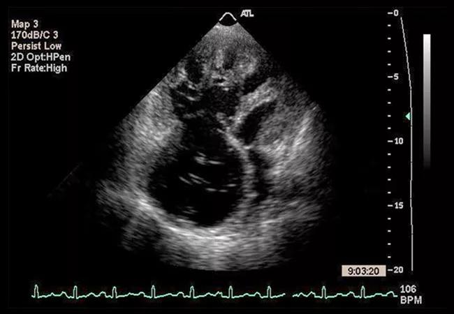 Right-sided heart failure: A useful new document from the Am Heart Assn considers all major topics relevant to this syndrome