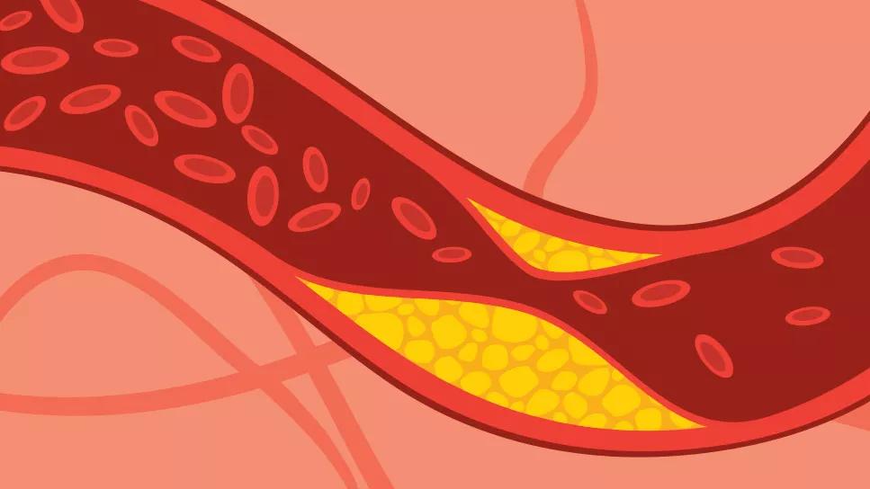 Cholesterol blocking blood flow in artery
