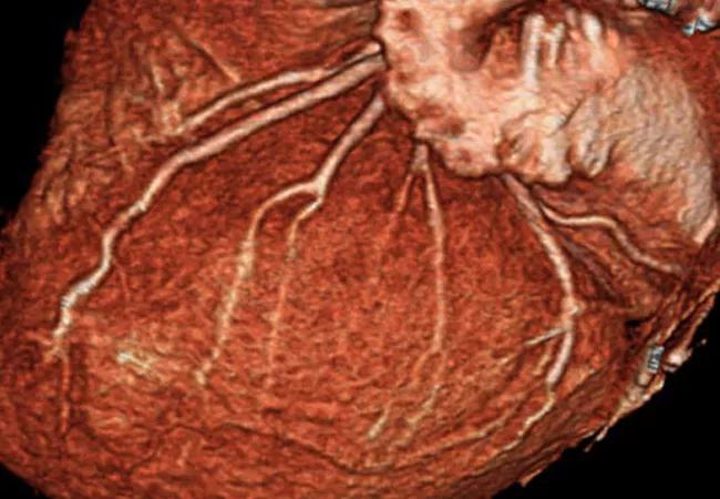 CT angiogram of the heart