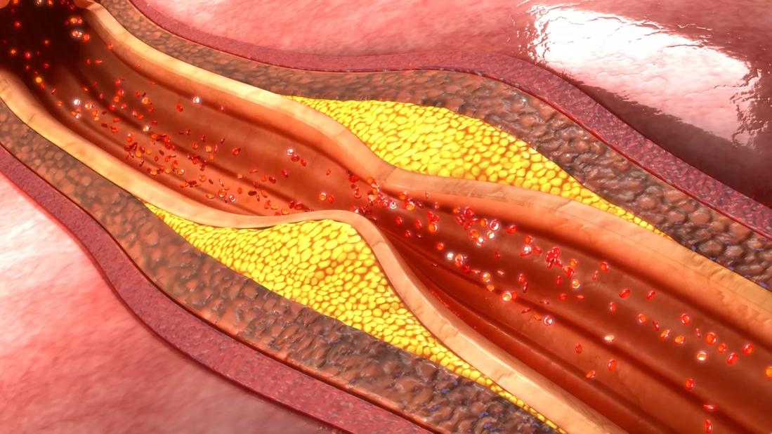 peripheral-artery-disease_650x450